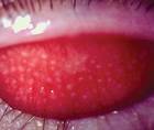 Giant Papillary Conjunctivitis Diagnostic Pearls