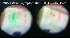 lissamine green staining on the superior bulbar conjunctiva before BTX