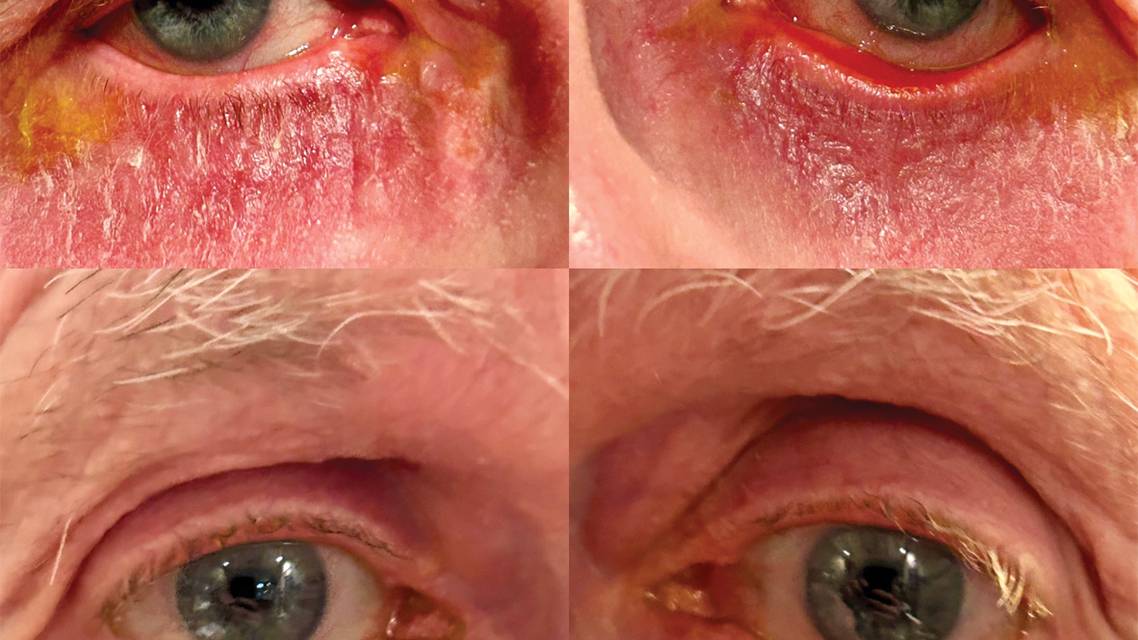 Ectropion in the Setting of Glaucoma