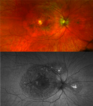 NIH Researchers Discover New Genetic Eye Disease image