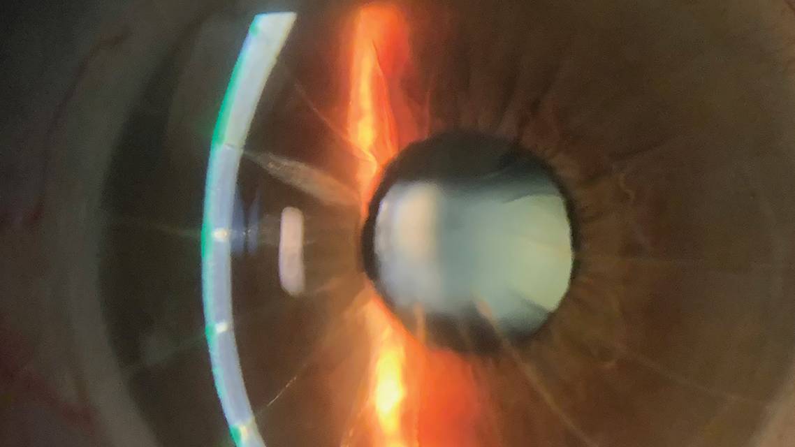 Get Medical With Your Contact Lens Prescribing