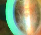 microcytic keratopathy in a patient who underwent Elahere therapy