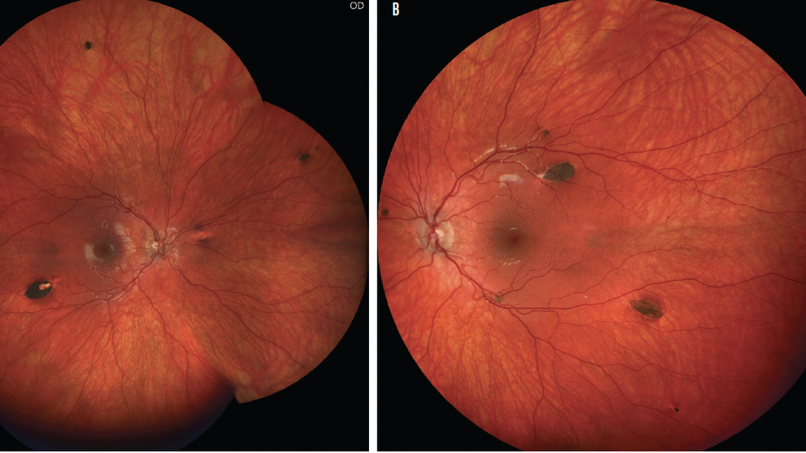 Familial Adenomatous Polyposis