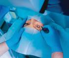 refractive surgery