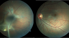 Persistent Fetal Vasculature