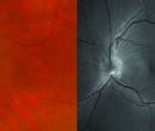 Fundus photography showed superior optic nerve edema OS with a normal and red free filter