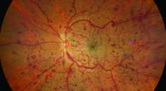 retina image of retinal vein occlusion