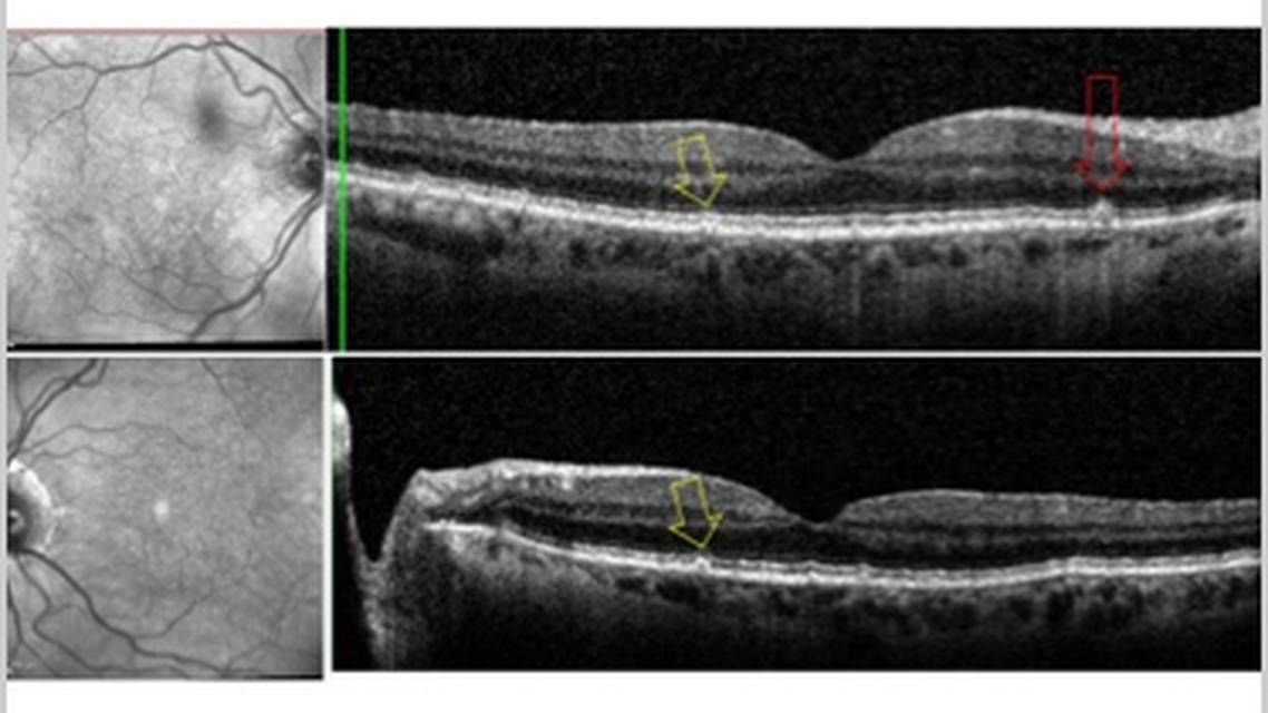 GA Case Compendium Simultaneous Development of Geographic Atrophy and Wet AMD in a Patient Lost to Follow up