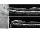 GA Case Compendium Simultaneous Development of Geographic Atrophy and Wet AMD in a Patient Lost to Follow up