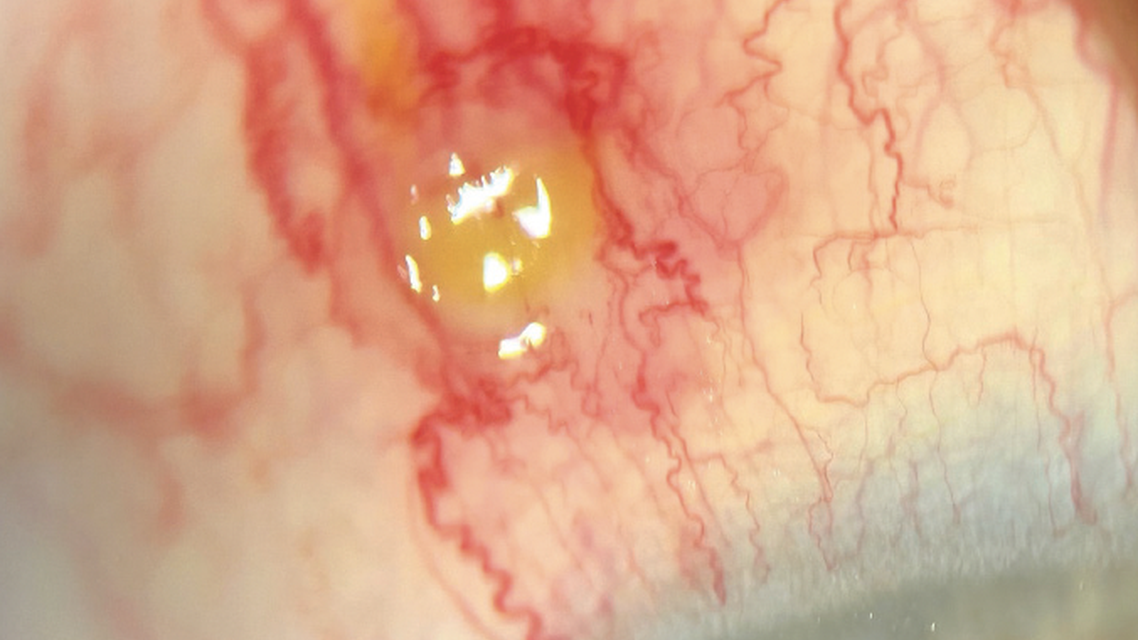 Giving a Nod to Nodular Episcleritis