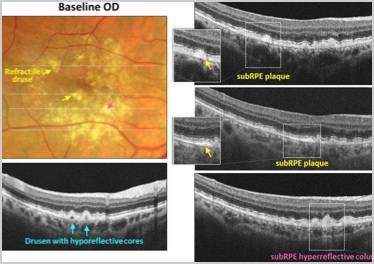 GA Case Compendium Identifying High Risk Biomarkers for Geographic Atrophy Development and Multimodal Imaging Strategies for