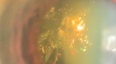 Christmas Tree Cataract