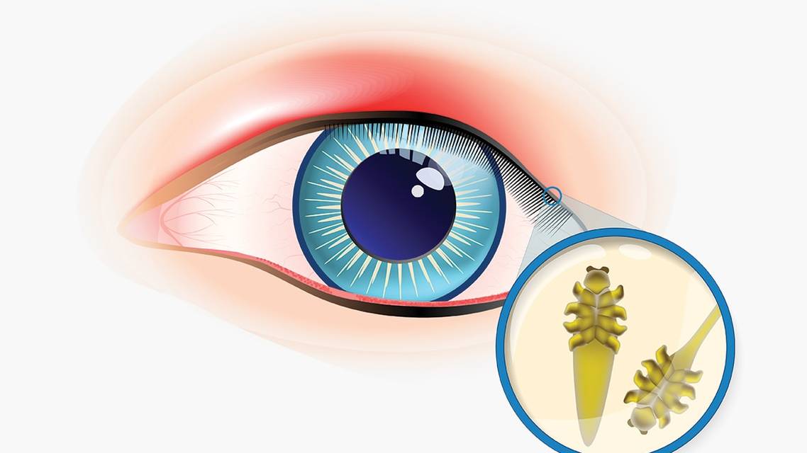 A Primer on Demodex Blepharitis