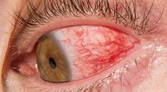 Not Your Typical Scleritis