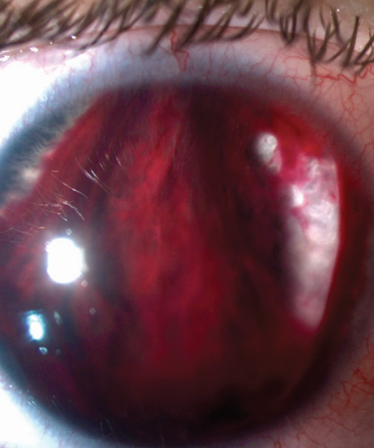Hyphema