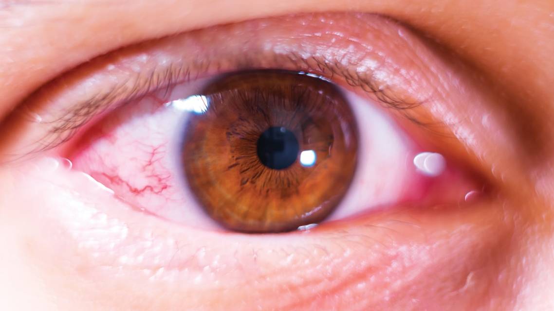An Updated Overview of Inflammatory Dry Eye
