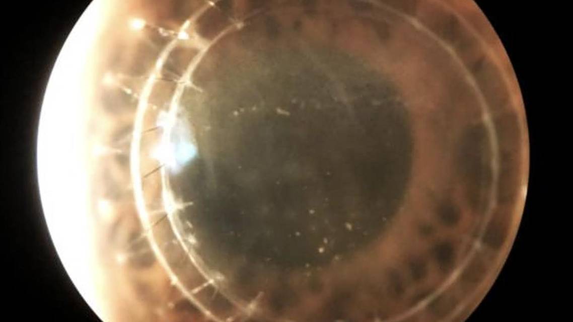 Corneal Graft Rejection Versus Failure