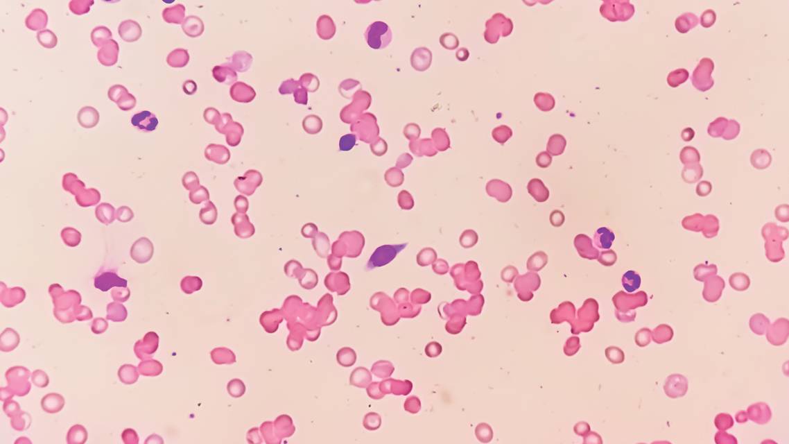 Retinal Imaging in Hematologic Disorders