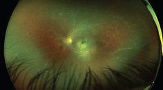 Pacifying a Parasite