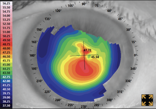 Enhancing Patient Outcomes With Light Adjustable Lenses