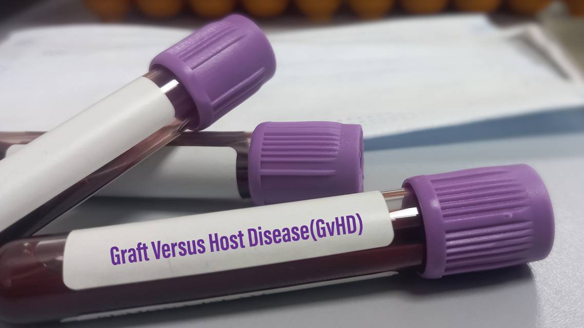 The Ocular Manifestations of GVHD