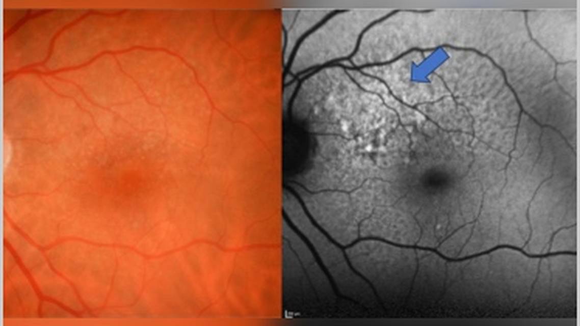 Clinical Case Compendium A Journey Through Detection Treatment Initiation and 2 Years of Active Complement Inhibition