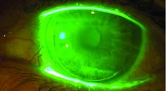 dry eye image