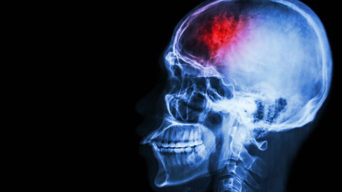 Caring for Concussed Patients in the ODs Office