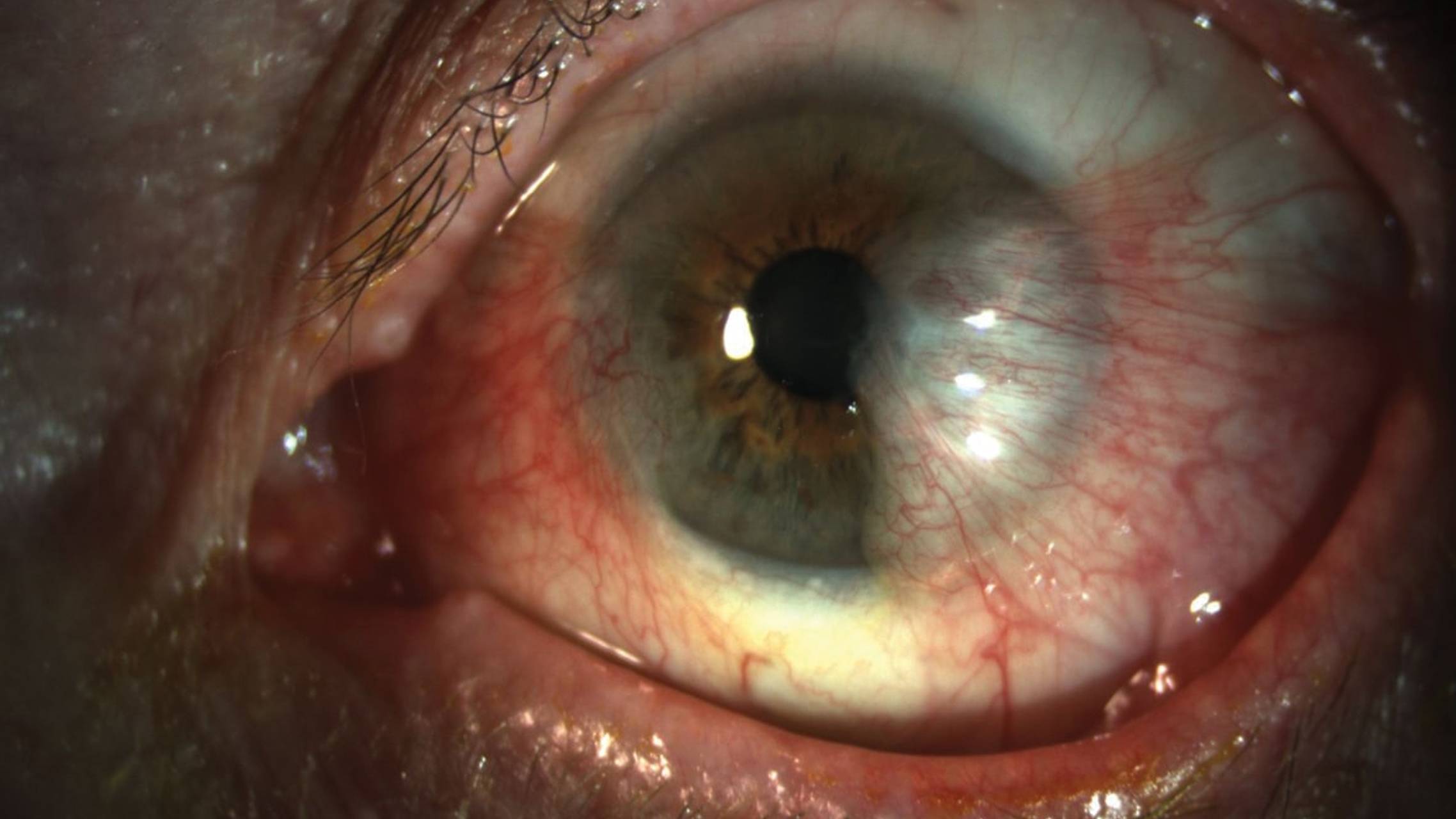 Key Identifiers in Cancerous Conjunctival Lesions