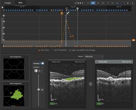 Study Examines AI-Driven Home OCT for Tracking Wet AMD Disease Activity image