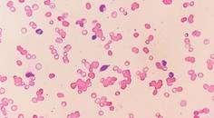 Retinal Imaging in Hematologic Disorders
