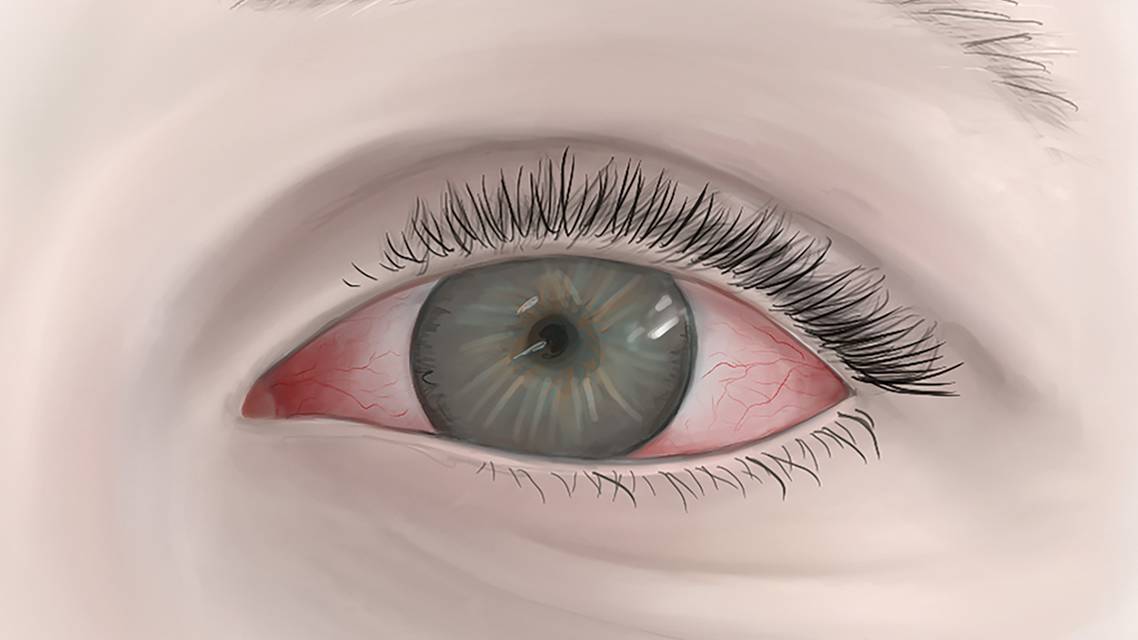 Is It Sjögren Syndrome or Something Else