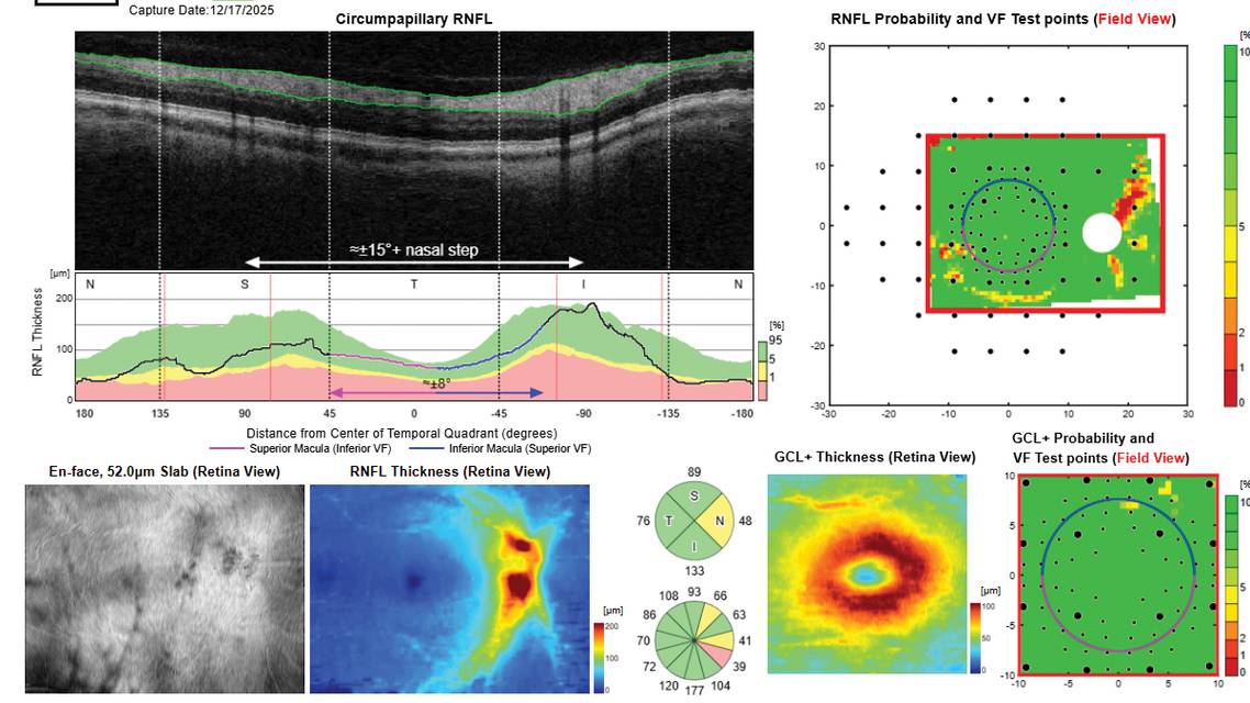 OCT imaging of glaucoma