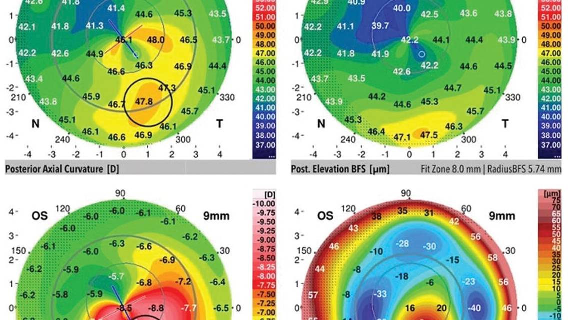 The Art and Science of Managing Post LASIK Keratectasia