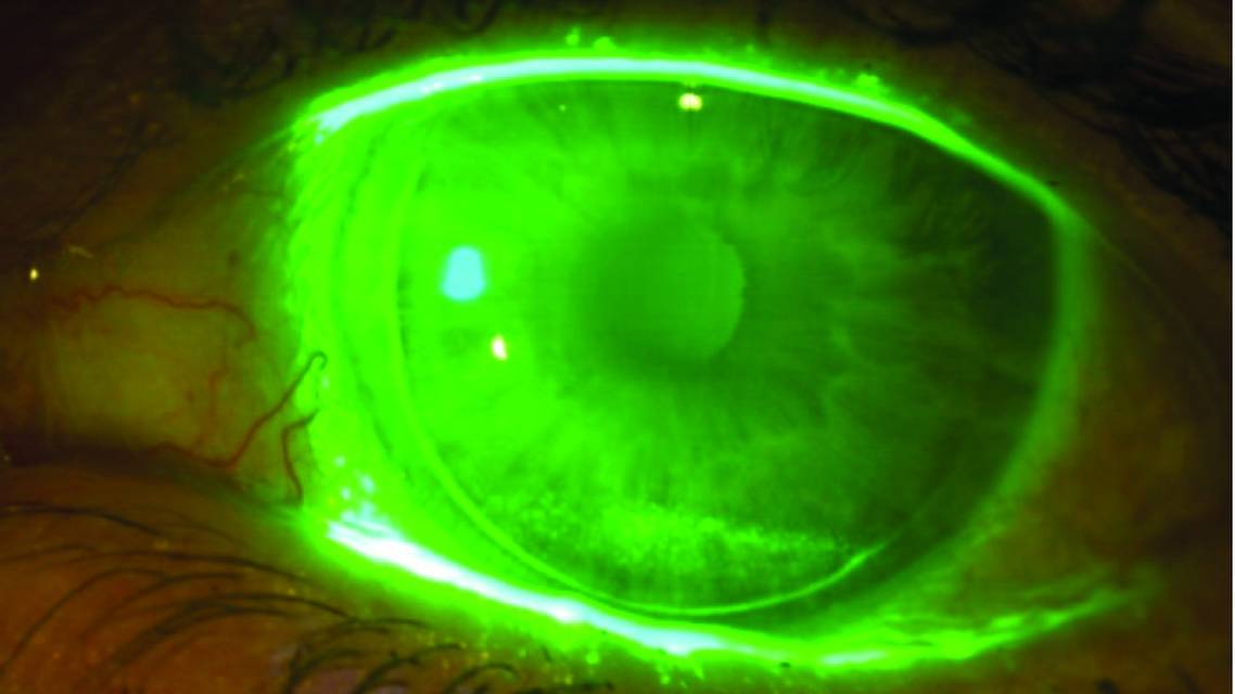 dry eye image