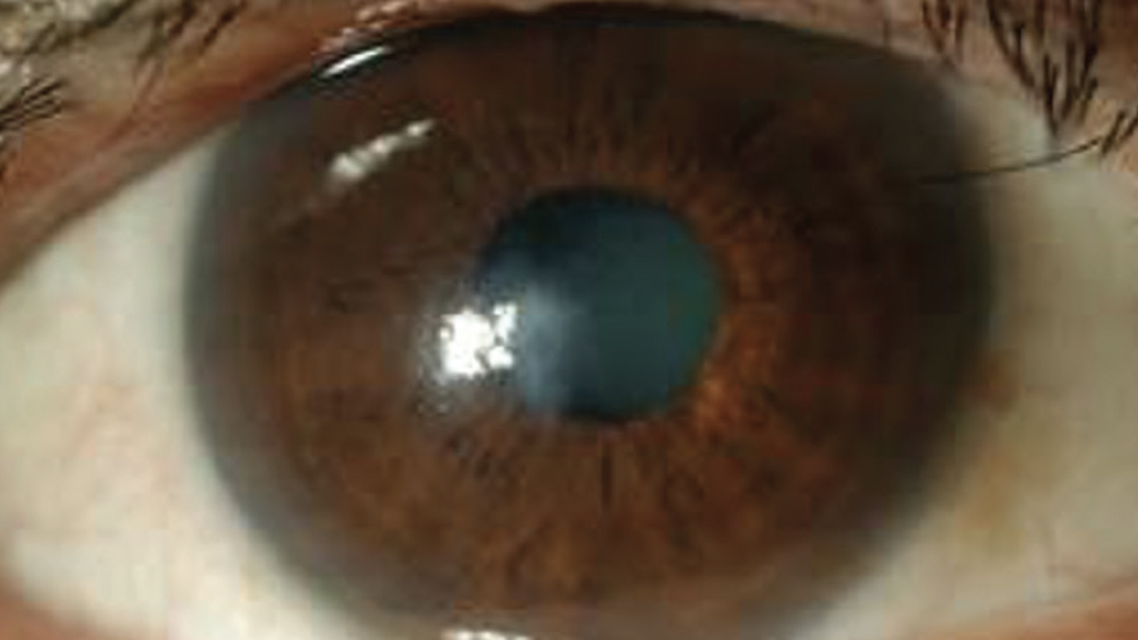 Updates in Keratoconus Management and the FDA Approved iLink Cross Linking Procedure