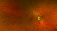 Collaborative Case 005 Things that Bug the Retina