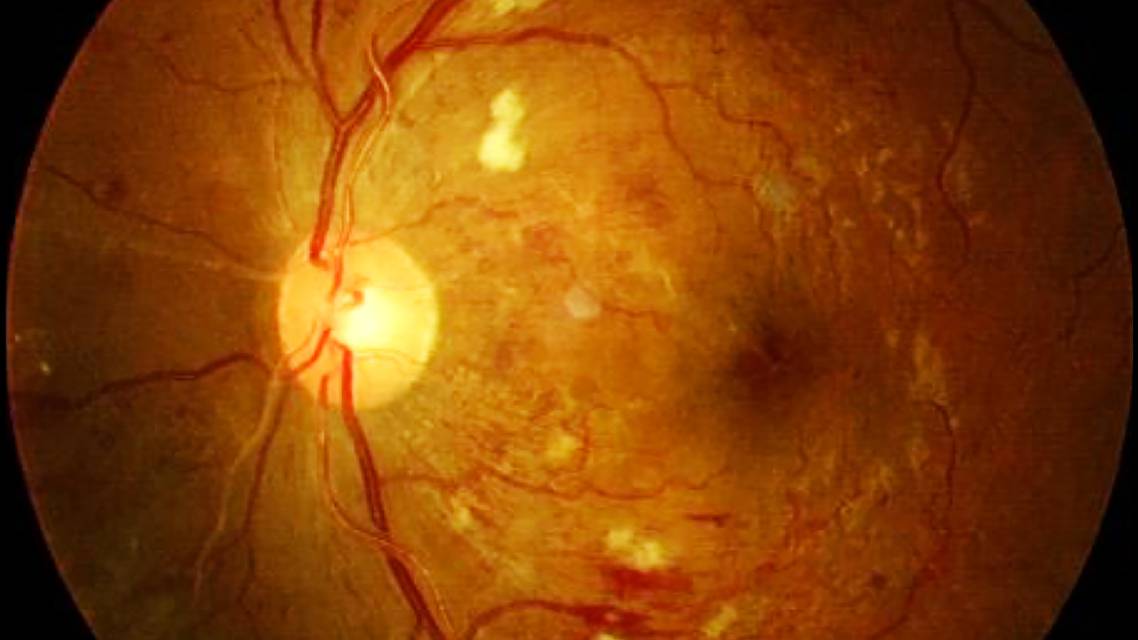 Medical Management of Diabetic Retinopathy