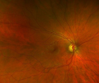 Collaborative Case 005 Things that Bug the Retina