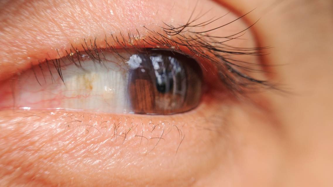 eye with dry eye