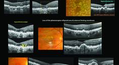 OCT images