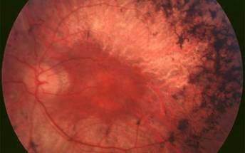 Study: Blindness from some inherited eye diseases may be caused by gut bacteria image