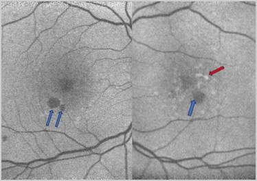 GA Case Compendium Rapid Loss of Vision Associated With Geographic Atrophy