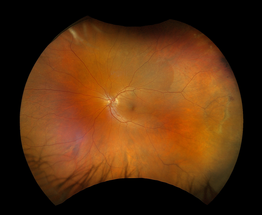 Optos Announces New Ultra-Widefield Color Image Modality, Providing Additional Retinal Visualization image