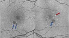 GA Case Compendium Rapid Loss of Vision Associated With Geographic Atrophy