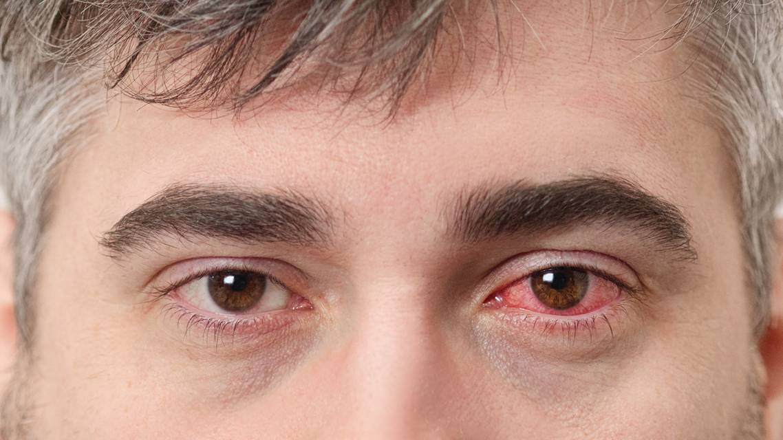 Catching a Red Eye