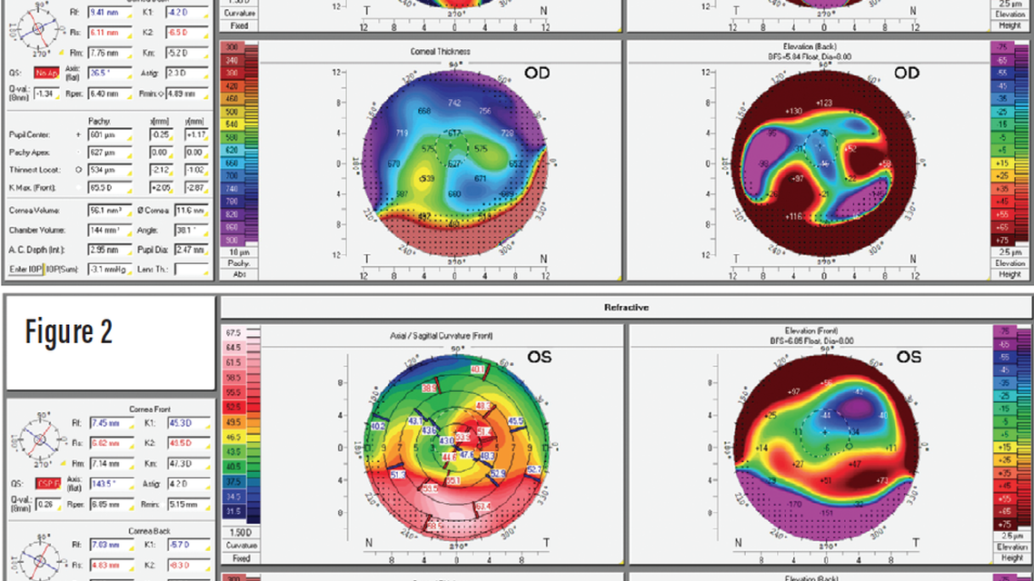 Pentacam CSP Software to Improve Efficiency and Efficacy of Complex Custom Scleral Lens Design