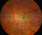 retina image of retinal vein occlusion