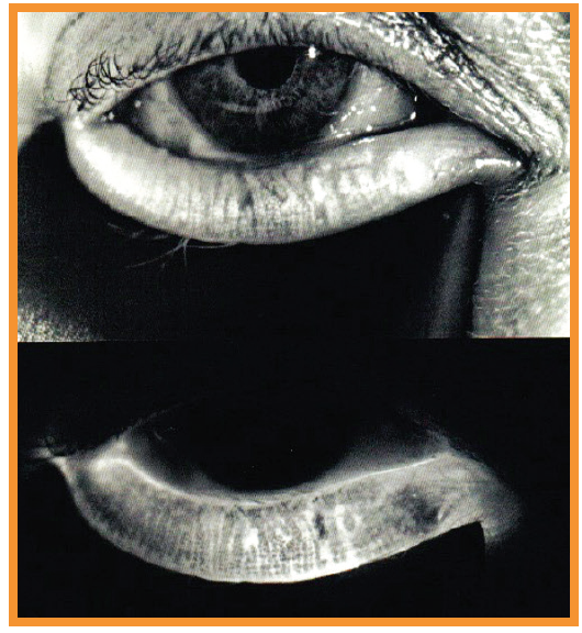 Evolving Concepts in Anterior Segment Outcomes Tackling Ocular Surface Disease Comanaging Premium IOL Patients and Identif