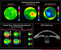 FDA Clears Epithelial Thickness Module for Heidelberg Engineering’s Anterion Multidisciplinary Imaging Platform image